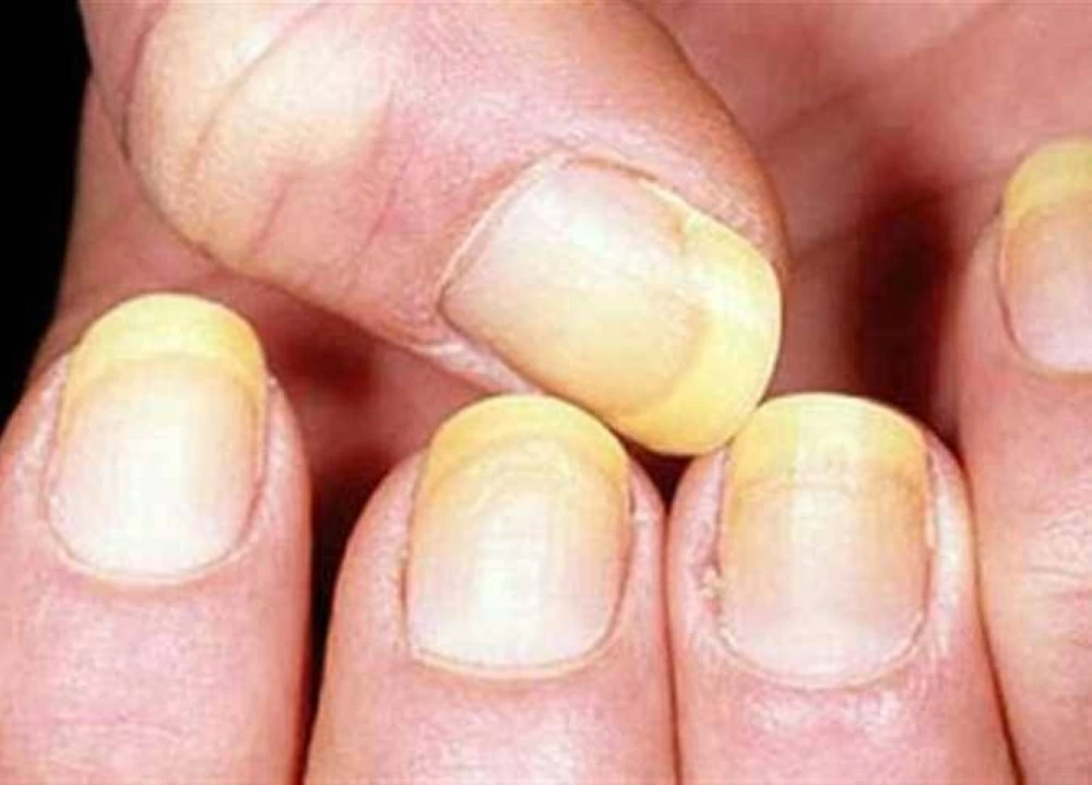 «باى باى الضوافر الصفرا».. بالليمون وبيكربونات الصوديوم احصلى على أظافر بيضاء