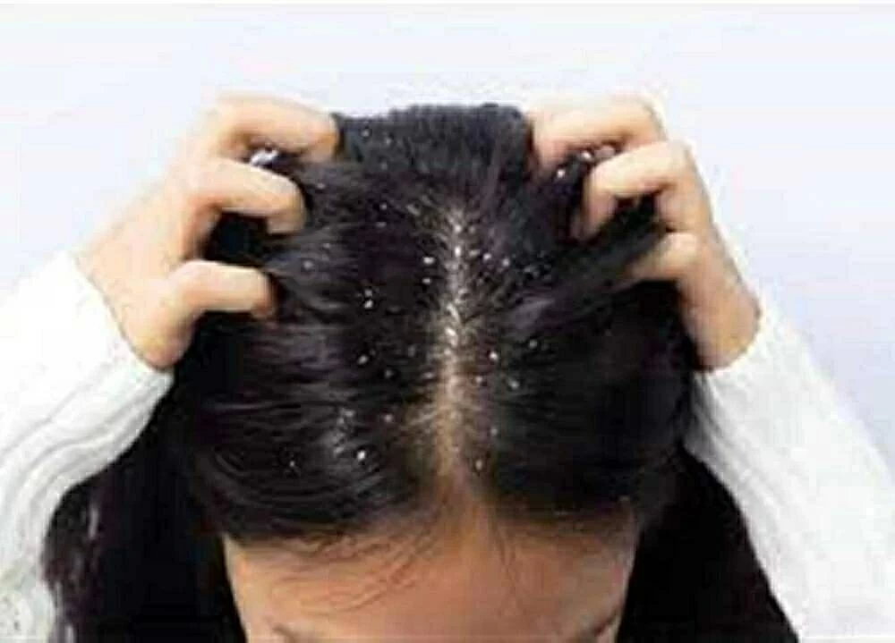 تجنبها فورًا.. 5 أخطاء شائعة تفاقم قشرة الشعر في الشتاء